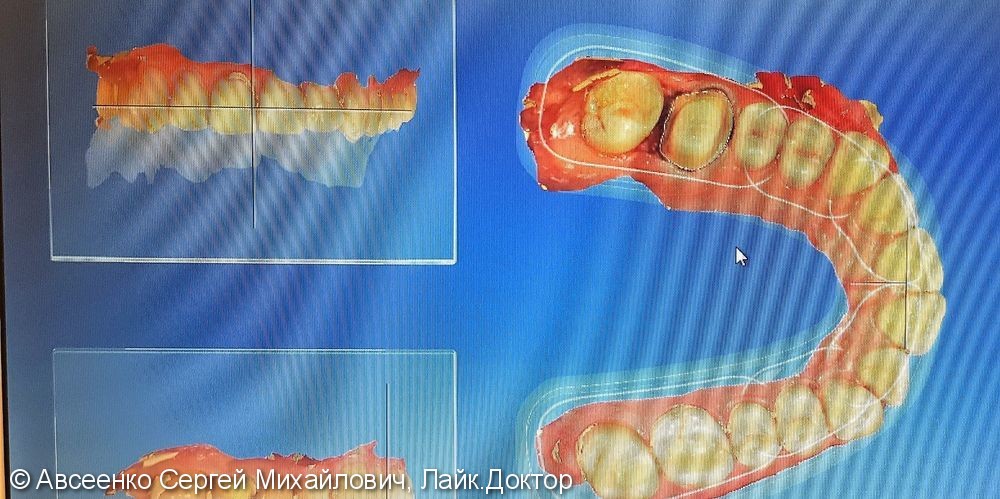 Восстановление зуба керамической реставрацией с использованием технологии CEREC - фото №4