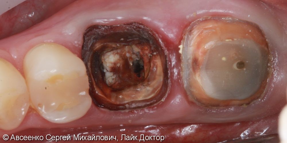 Восстановление двух зубов с установкой циркониевых коронок, в том числе на имплант - фото №1