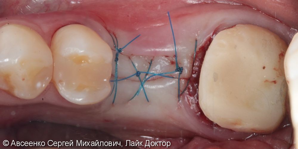 Восстановление двух зубов с установкой циркониевых коронок, в том числе на имплант - фото №2