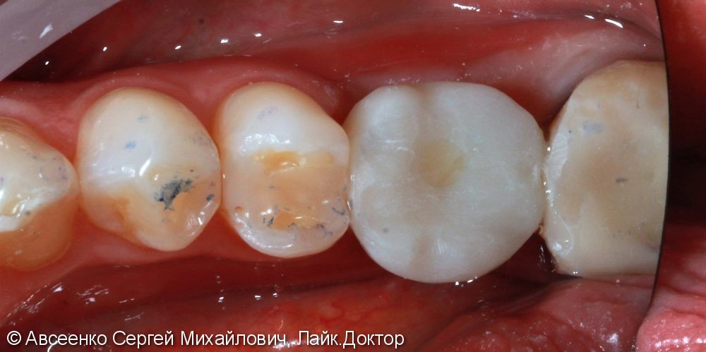 Восстановление двух зубов с установкой циркониевых коронок, в том числе на имплант - фото №3