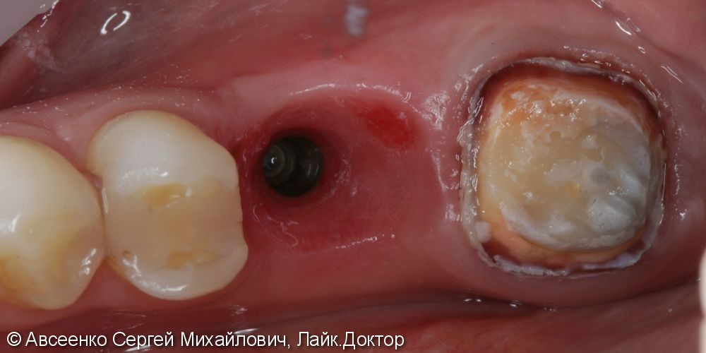Восстановление двух зубов с установкой циркониевых коронок, в том числе на имплант - фото №4