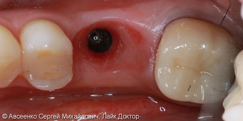 Восстановление двух зубов с установкой циркониевых коронок, в том числе на имплант - фото №5