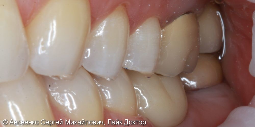 Восстановление двух зубов с установкой циркониевых коронок, в том числе на имплант - фото №6