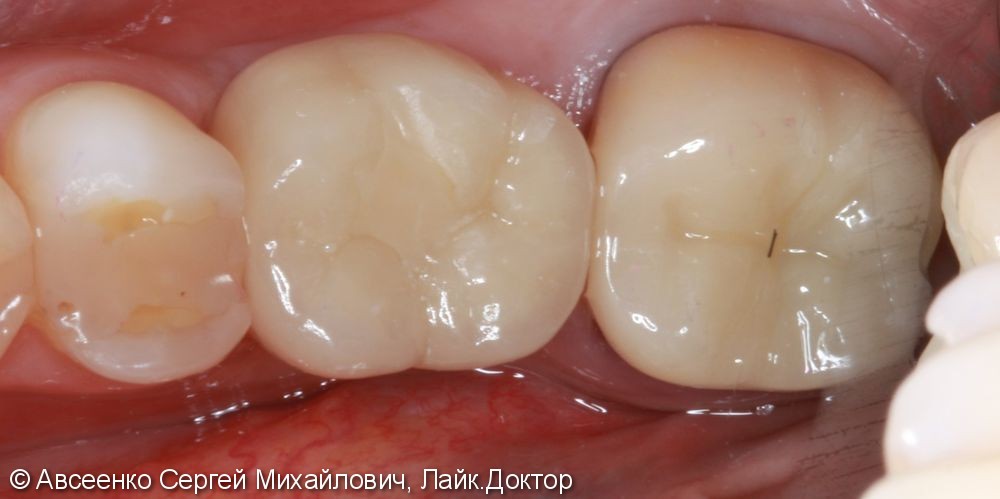 Восстановление двух зубов с установкой циркониевых коронок, в том числе на имплант - фото №7