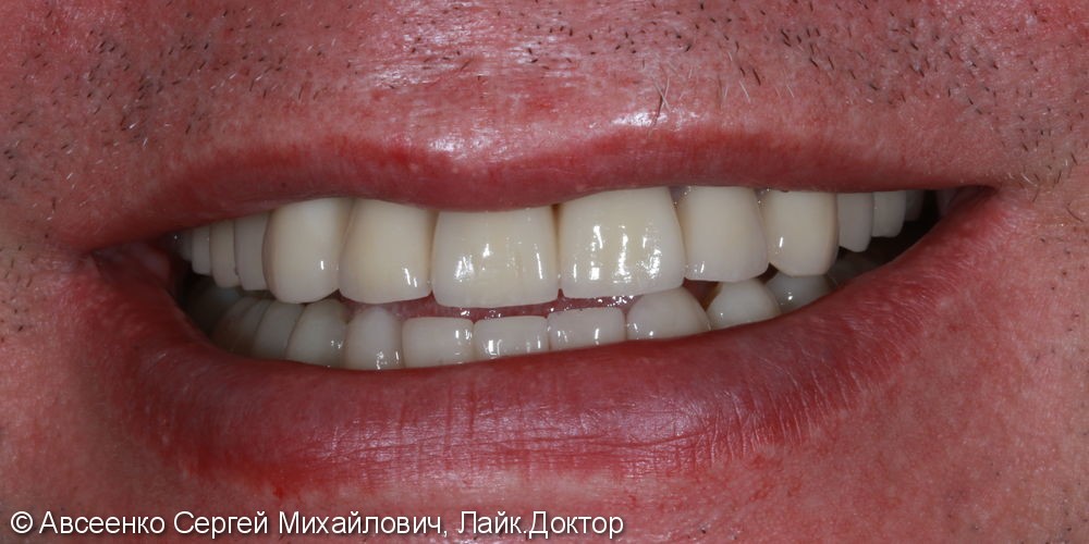 Восстановление зубных рядов с помощью имплантов и коронок - фото №9