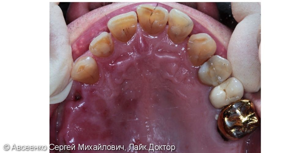 Восстановление зубных рядов с помощью имплантов и коронок - фото №3