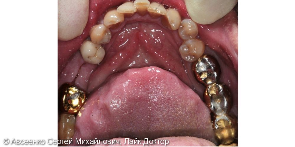Восстановление зубных рядов с помощью имплантов и коронок - фото №4