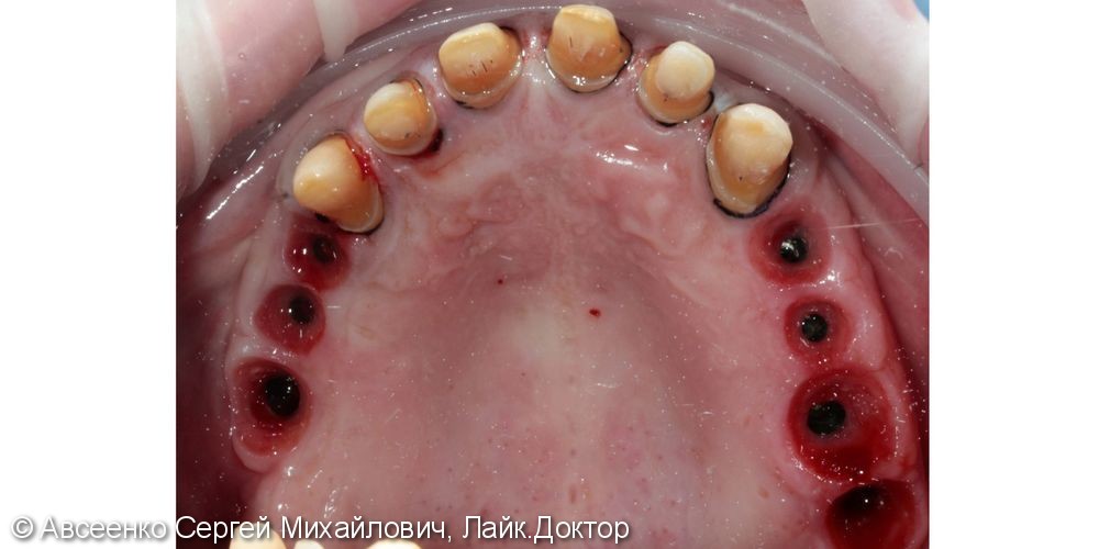 Восстановление зубных рядов с помощью имплантов и коронок - фото №6