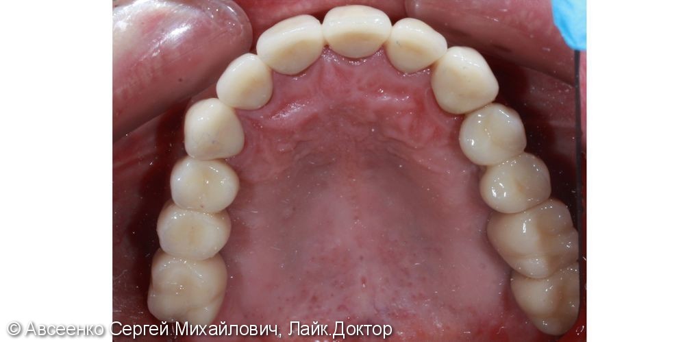 Восстановление зубных рядов с помощью имплантов и коронок - фото №7