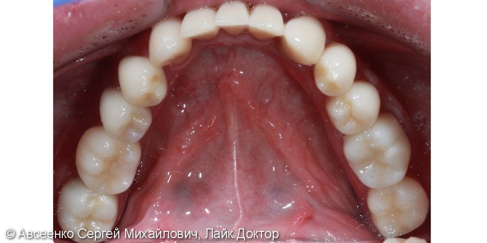 Восстановление зубных рядов с помощью имплантов и коронок - фото №8