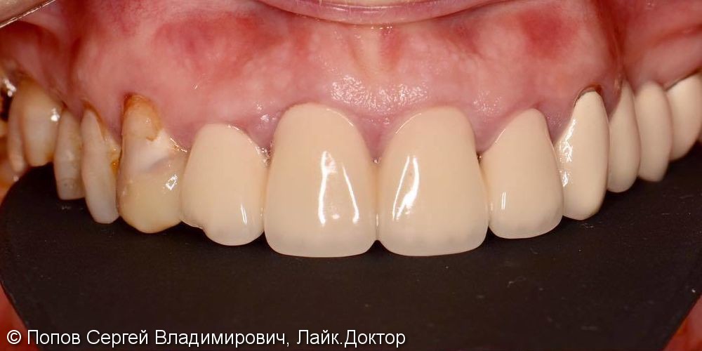 Небольшое изменение верхнего зубного ряда новыми коронками - фото №1