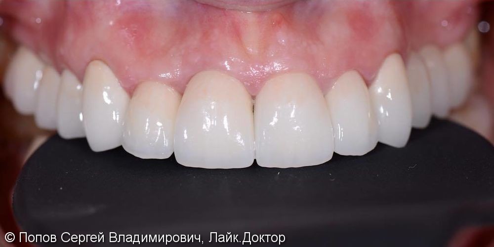 Небольшое изменение верхнего зубного ряда новыми коронками - фото №2