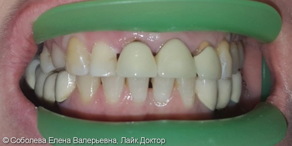 Протезирование зубов ВЧ коронками из безметалловой керамики E.max Press - фото №1