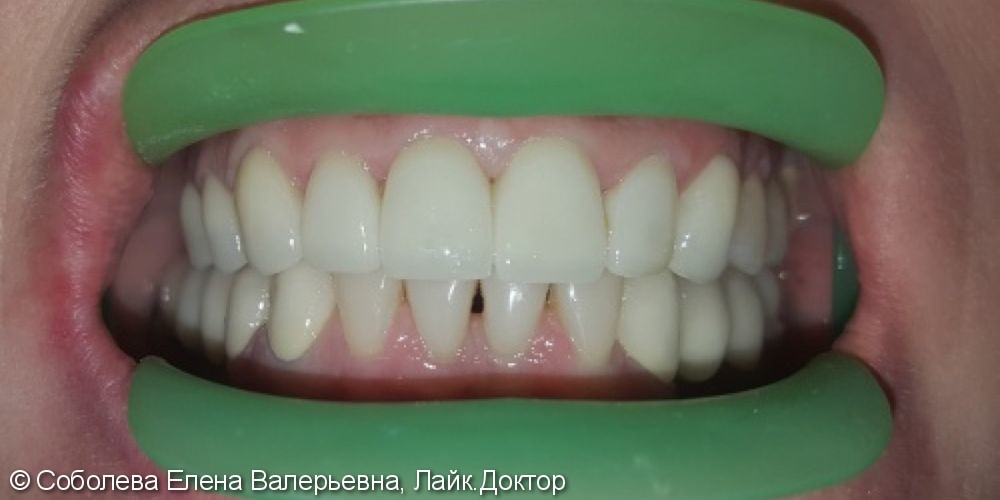 Протезирование зубов ВЧ коронками из безметалловой керамики E.max Press - фото №2
