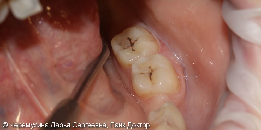 Лечение глубокого кариеса жевательных зубов 3.6 и 3,7 - фото №1