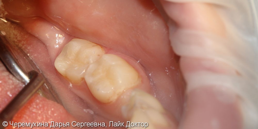 Лечение глубокого кариеса жевательных зубов 3.6 и 3,7 - фото №2