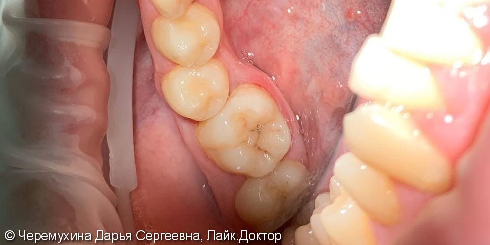Лечение глубокого кариеса зуба 3.6 - фото №1