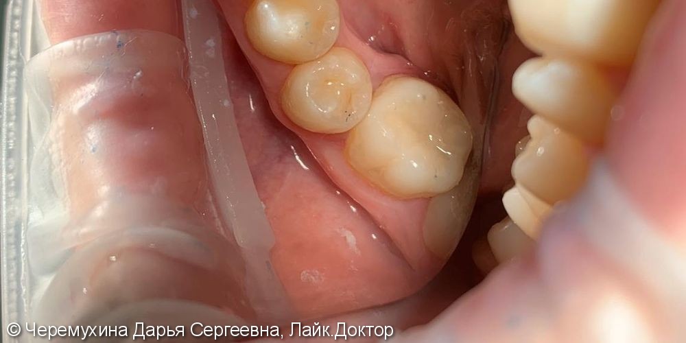 Лечение глубокого кариеса зуба 3.6 - фото №2
