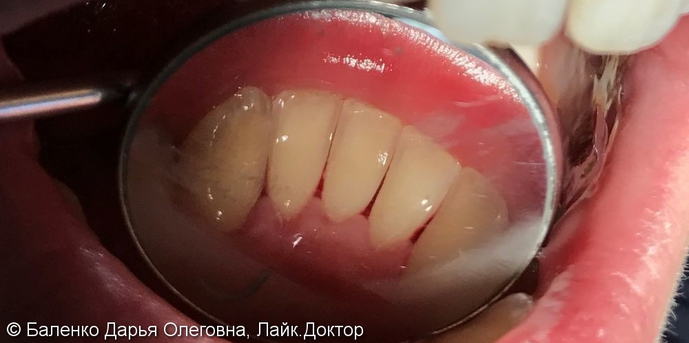 Кровоточивость десен, неприятный запах изо рта, профессиональная чистка зубов - фото №2