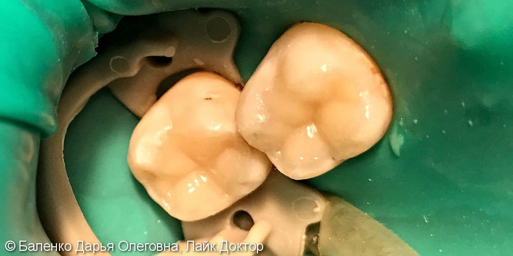 Пациент обратился с жалобой на наличие кариозных полостей в 2-х зубах - фото №2