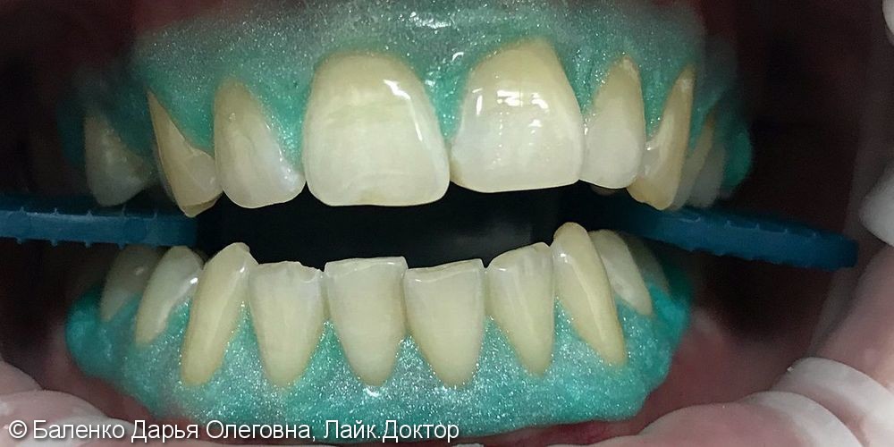 Результат отбеливания зубов Opalescence Boost 40% - фото №1