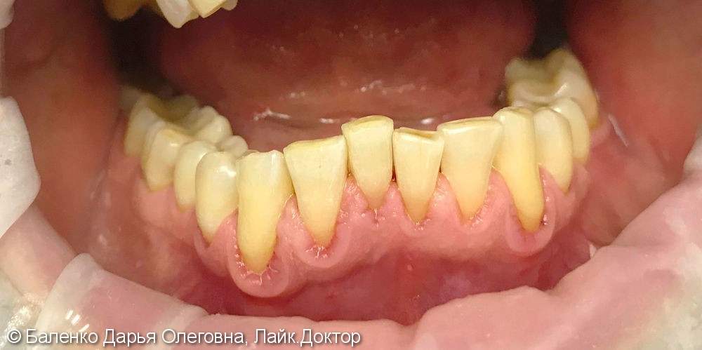 Жалобы на кровоточивость десен при читке зубов - фото №2
