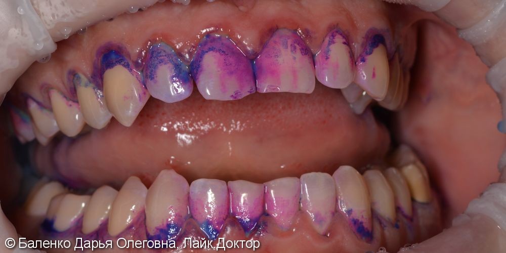 Жалоба на кровоточивость десен при чистке зубов - фото №1