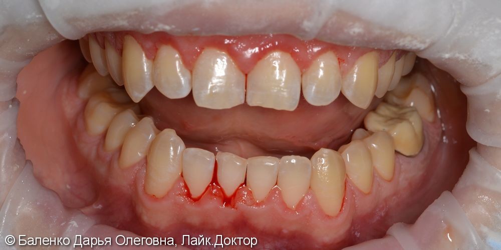 Жалоба на кровоточивость десен при чистке зубов - фото №2