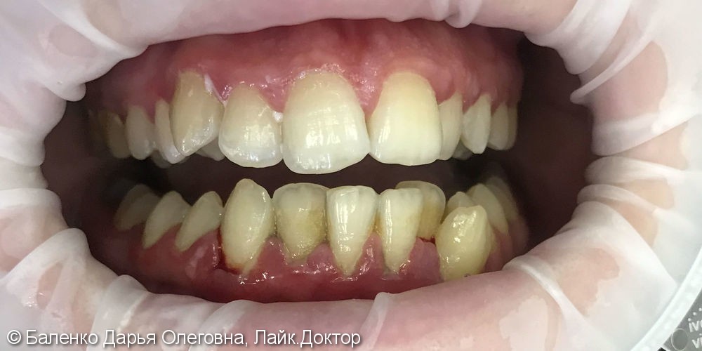 Жалобы на кровоточивость десен при читке зубов - фото №1