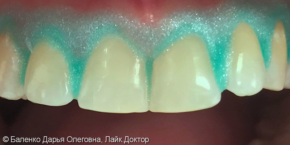 Отбеливание зубов верхней и нижней челюсти Opalescence Boost 40% - фото №1