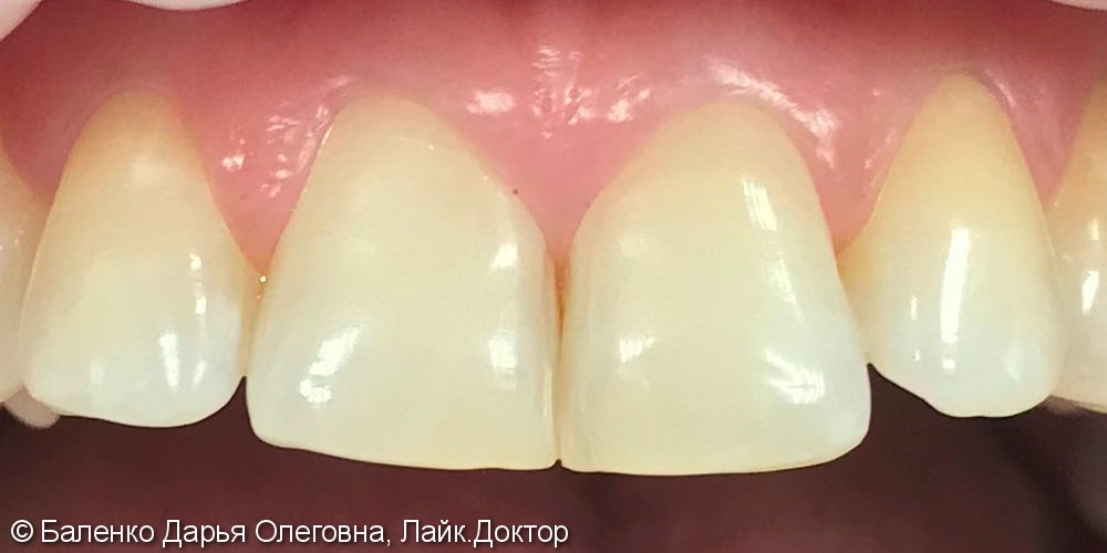 Отбеливание зубов верхней и нижней челюсти Opalescence Boost 40% - фото №2