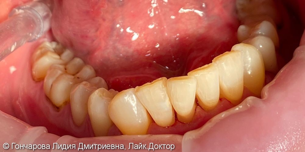 Гигиена зубов - фото №2