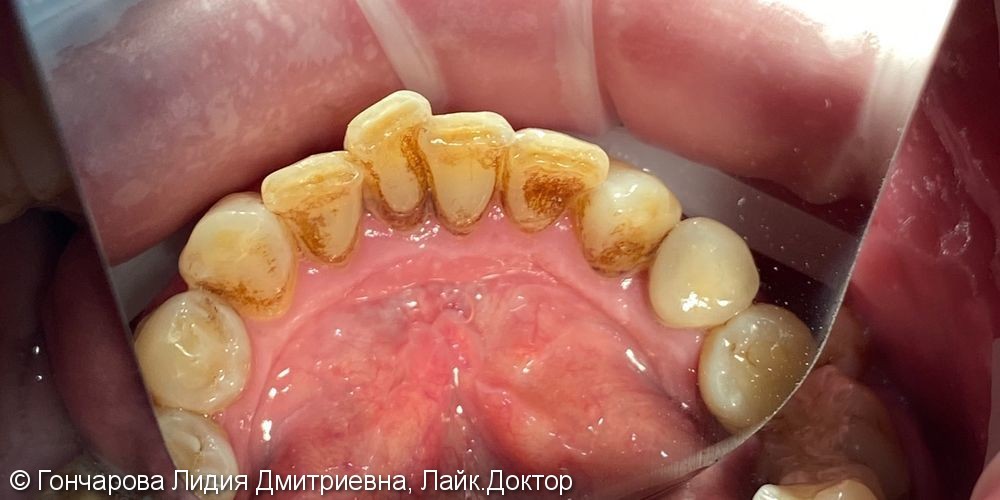 Гигиена зубов - фото №3