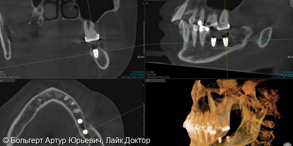Установка имплантатов в области 3.6, 3.7 - фото №3
