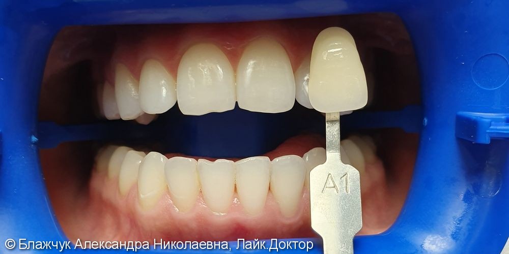 Результат отбеливания зубов ZOOM 4 - фото №1