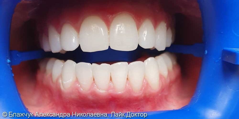 Результат отбеливания зубов ZOOM 4 - фото №2