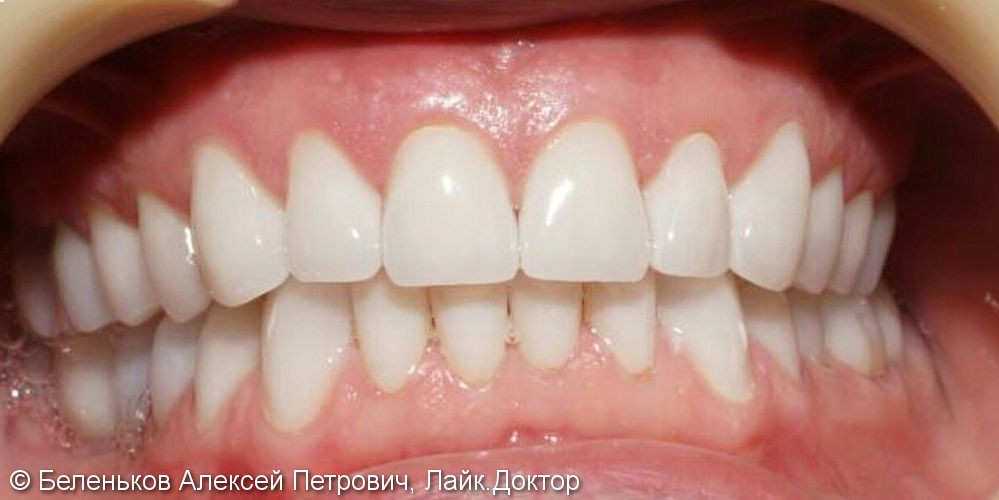 Коронки из диоксид циркония, совместная работа стоматолога и техника - фото №2