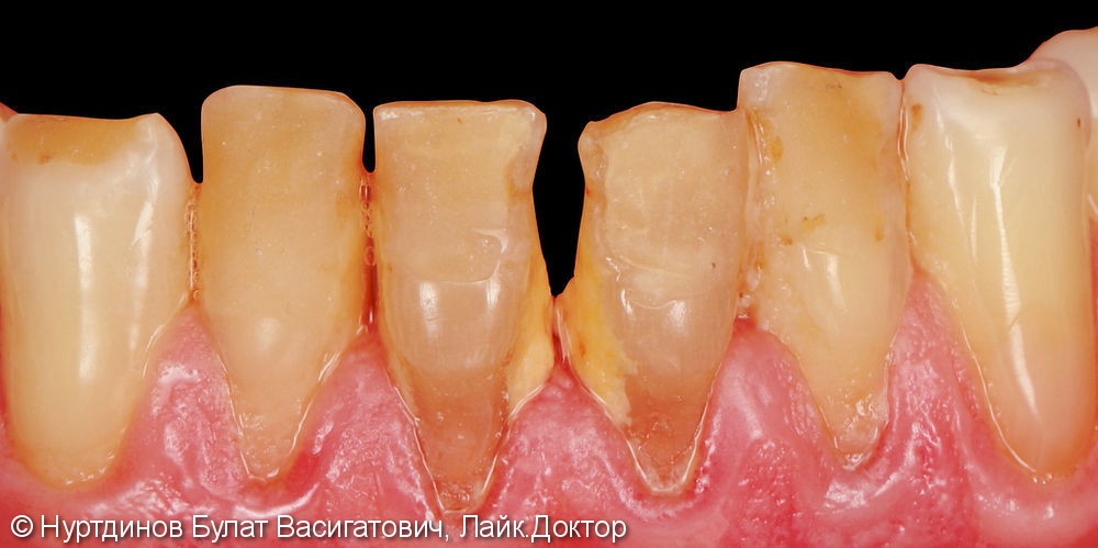 Керамическое покрытие на передние зубы нижней челюсти - фото №1
