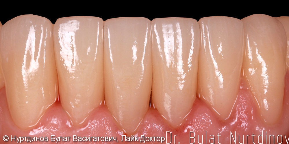 Керамическое покрытие на передние зубы нижней челюсти - фото №2
