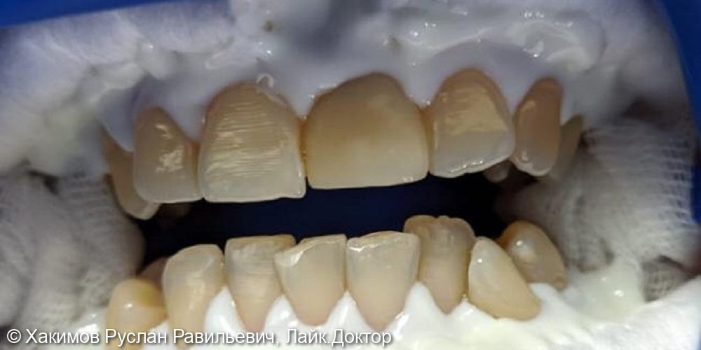 Профессиональная система отбеливания зубов ZOOM - фото №1