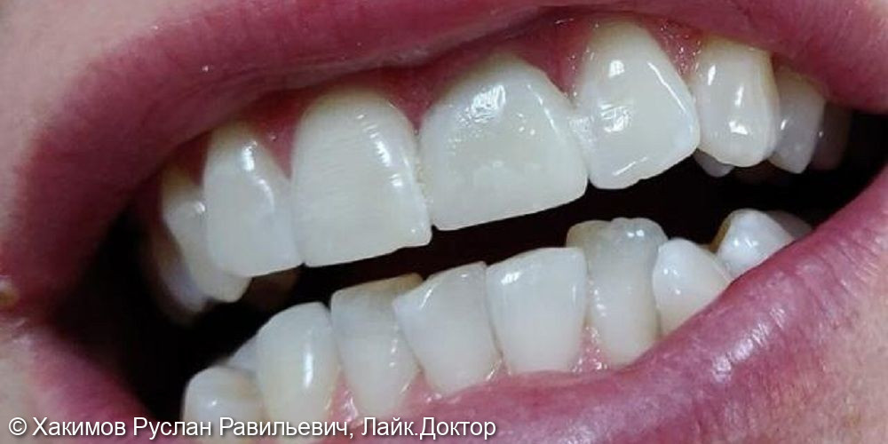 Профессиональная система отбеливания зубов ZOOM - фото №2