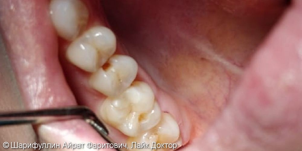 Лечение глубокого кариеса жевательного зуба 1.5 - фото №1