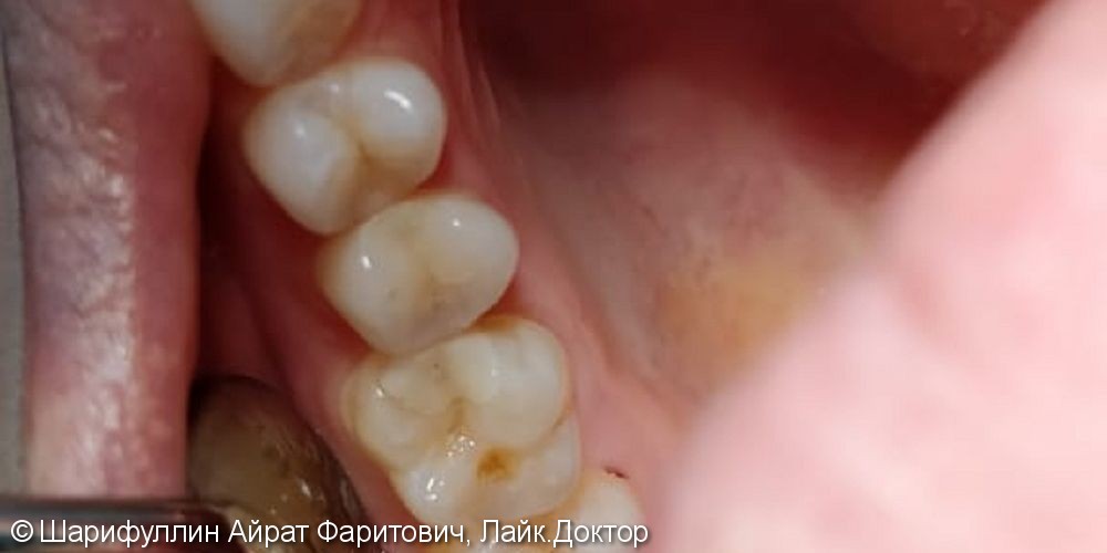 Лечение глубокого кариеса жевательного зуба 1.5 - фото №2