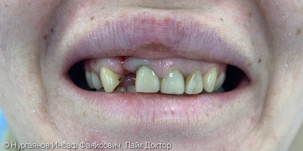 Тотальная реставрация зубного ряда верхней челюсти - фото №1