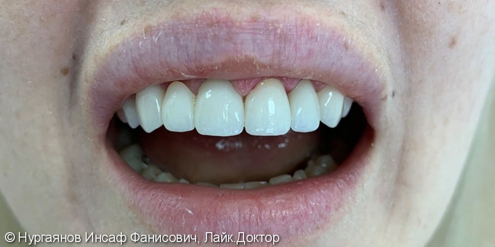 Тотальная реставрация зубного ряда верхней челюсти - фото №2