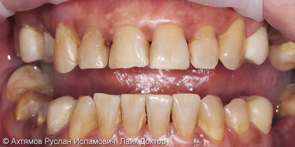 Изменение внешнего вида и протезирование боковых отделов зубных рядов - фото №1