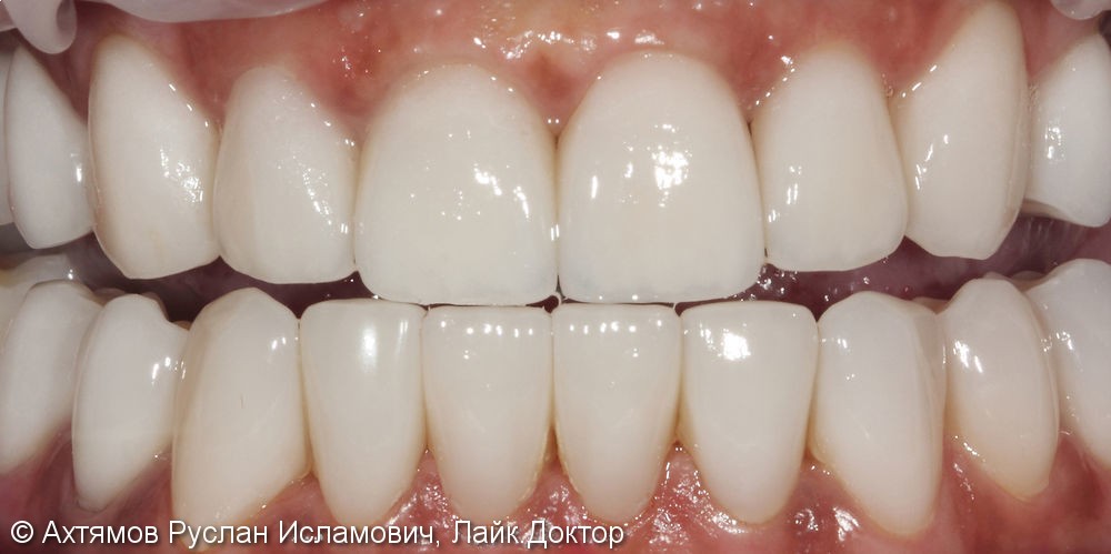 Изменение внешнего вида и протезирование боковых отделов зубных рядов - фото №2