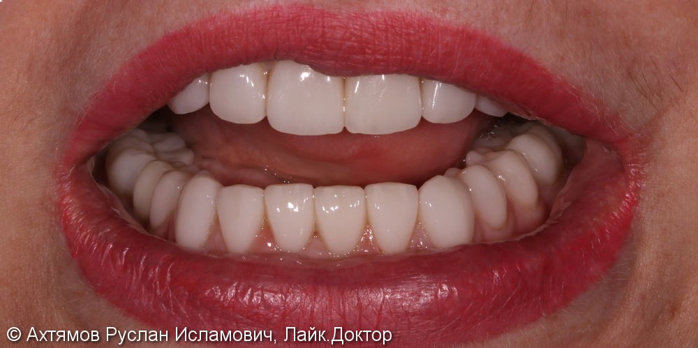 Полное восстановление зубных рядов керамическими винирами - фото №5