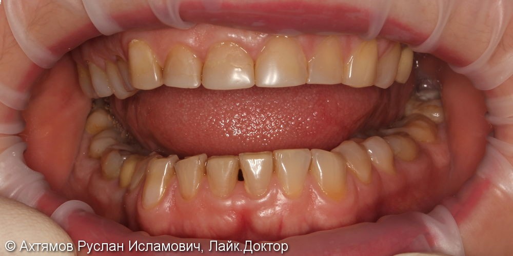 Полное восстановление зубных рядов керамическими винирами - фото №1