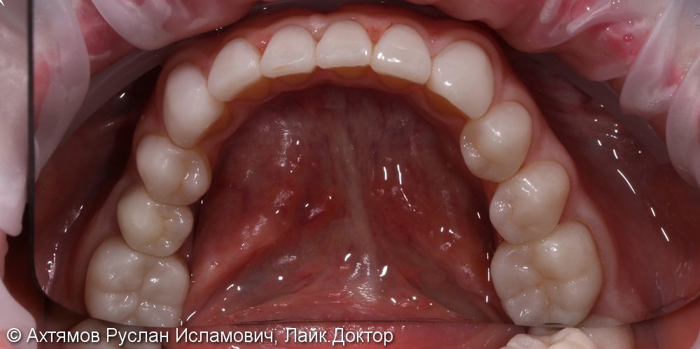 Полное восстановление зубных рядов керамическими винирами - фото №3